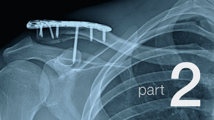 Recovering From A Broken Collarbone Part 2 05118 700×394